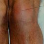 Knee Bursitis - Mayfair Wellness Clinic Gulshan