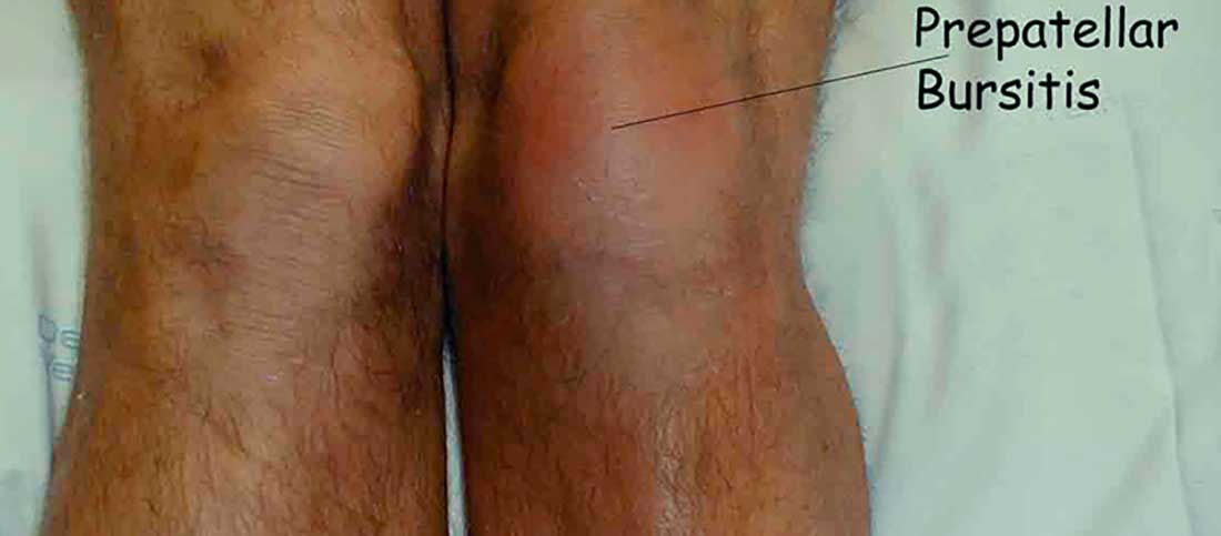 Knee Bursitis - Mayfair Wellness Clinic Gulshan