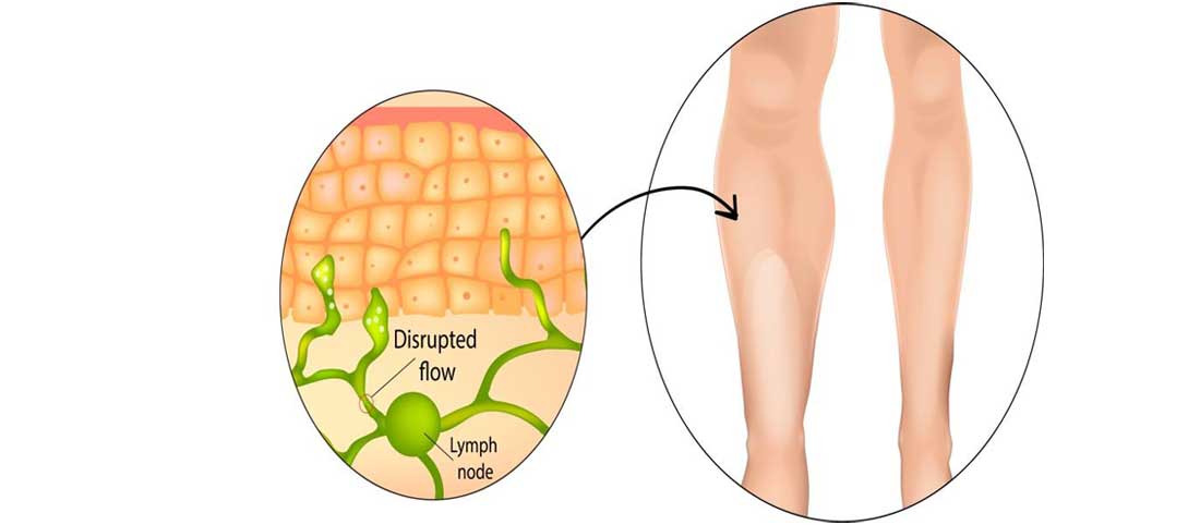 Lymphedema - Mayfair Wellness Clinic Gulshan
