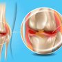 Meniscus Tear - Mayfair Wellness Clinic Gulshan