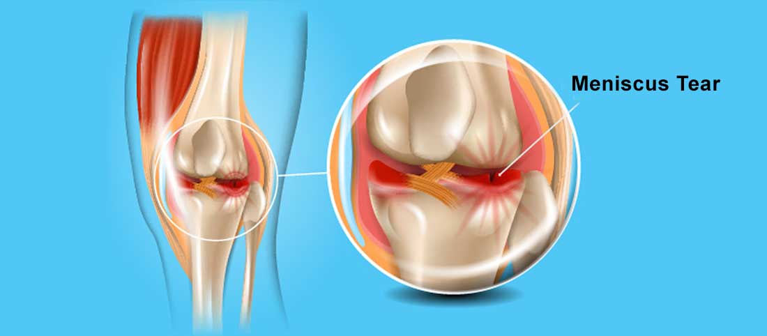 Meniscus Tear - Mayfair Wellness Clinic Gulshan