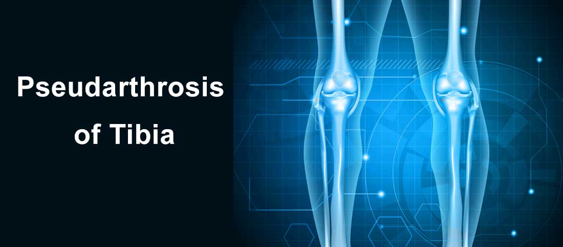 Pseudarthrosis Of Tibia - Mayfair Wellness Clinic Gulshan