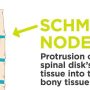 Schmorls Node - Mayfair Wellness Clinic Gulshan