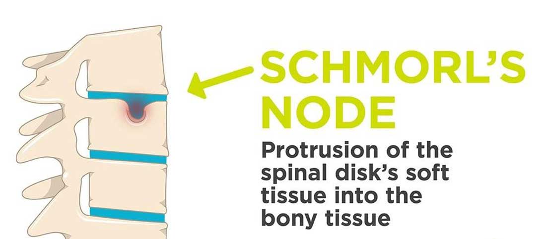 Schmorls Node - Mayfair Wellness Clinic Gulshan