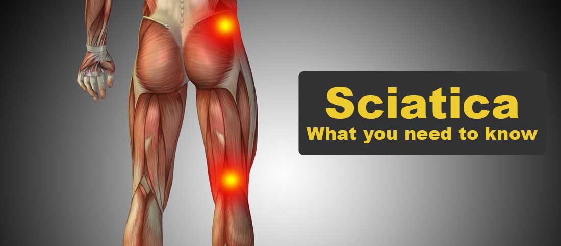 Sciatica What You Need To Know - Mayfair Wellness Clinic Gulshan