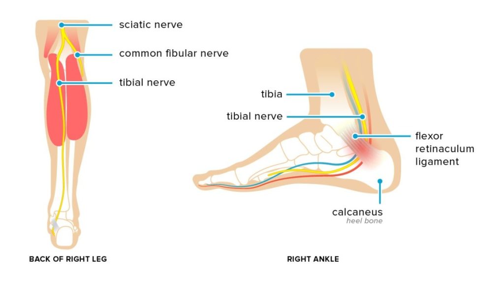 Tarsal tunnel Syndrome Tarsal tunnel Syndrome