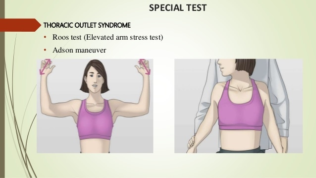 Thoracic Outlet Syndrome1 Thoracic Outlet Syndrome