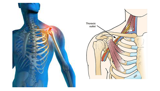 Thoracic Outlet Syndrome9 Thoracic Outlet Syndrome