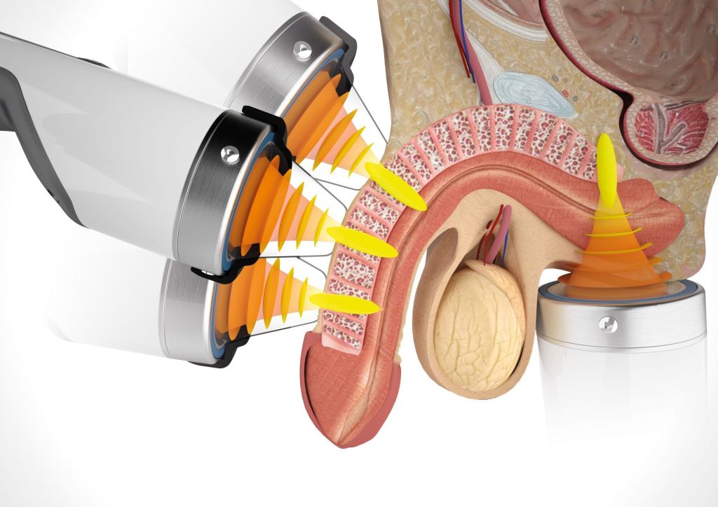 focused shockwave therapy for erectile dysfunction problem