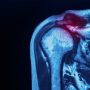 SLAP Tear - Mayfair Wellness Clinic Gulshan