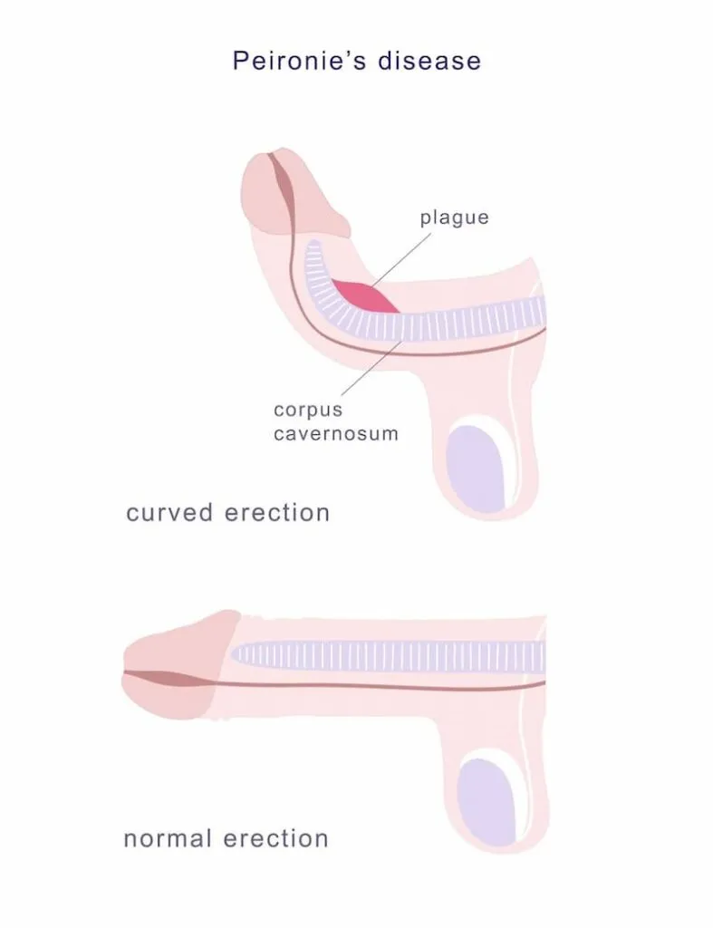 Peyronies Disease - Mayfair Wellness Clinic Gulshan